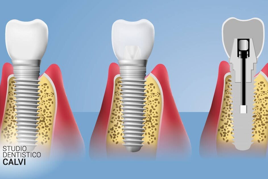 Impianti dentali | Studio dentistico Calvi