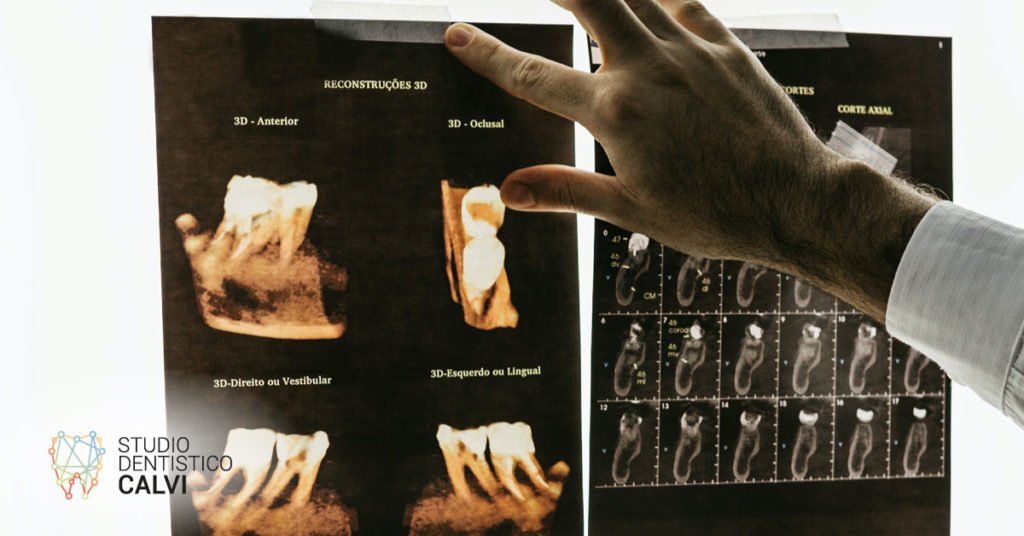 Dente che si muove: che cosa fare?